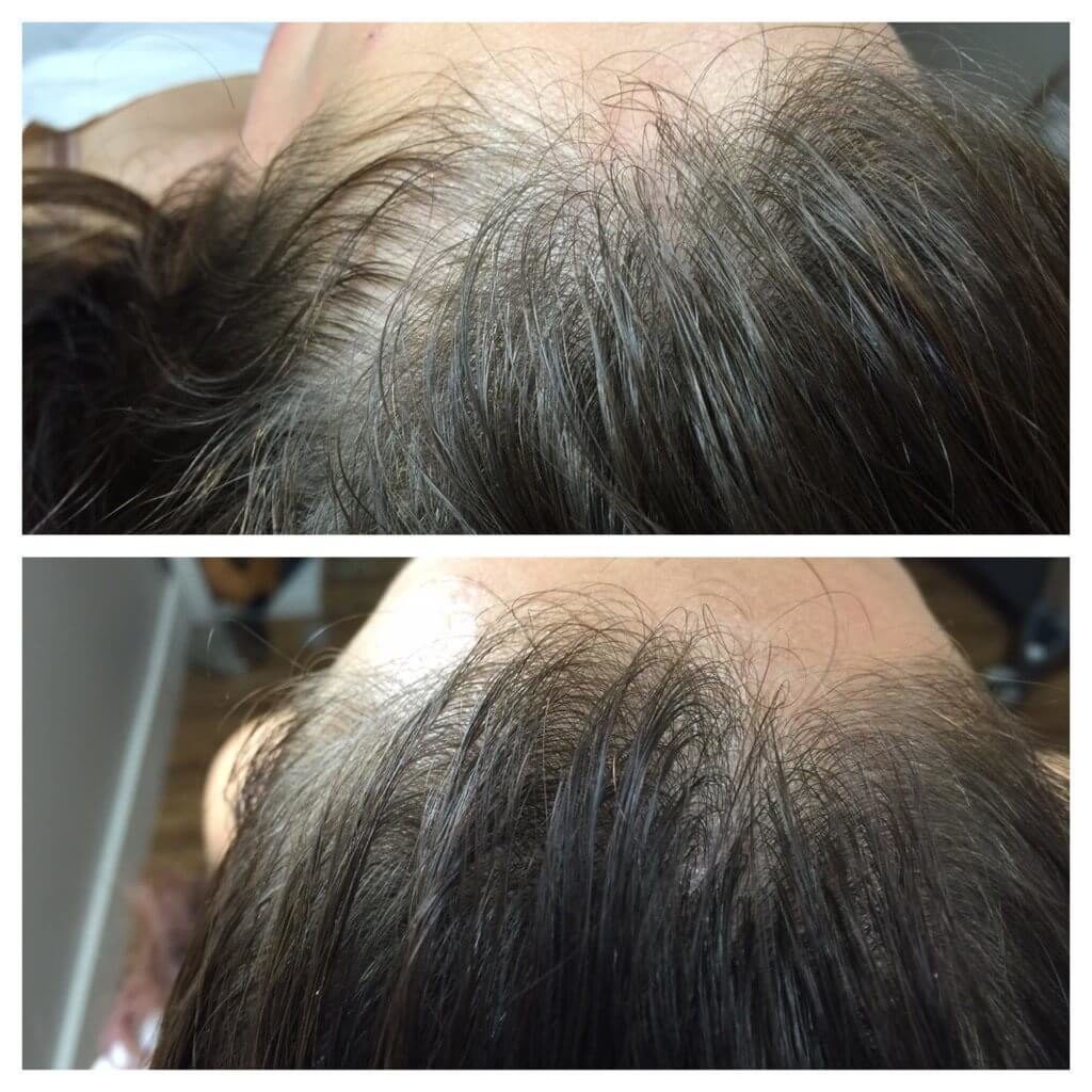 prp for hair loss, PRP for Hair Loss
