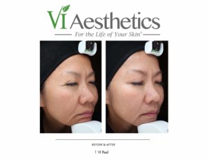 vi-peels-before-after