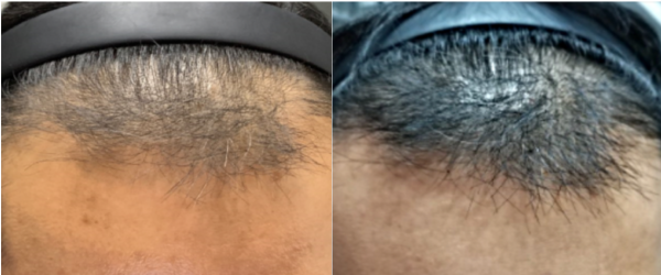 , Keralase: Cutting Edge Non-Surgical Treatment for Hair Loss